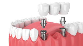 implantdisnedir