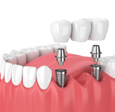 implantdisnedir